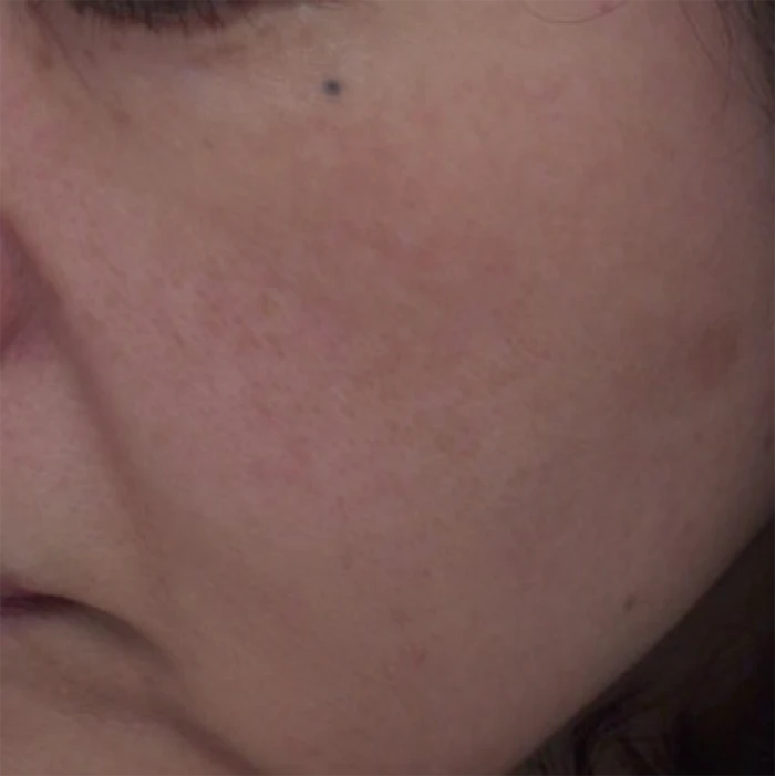 なのはな耳鼻咽喉科　After 5 treatments