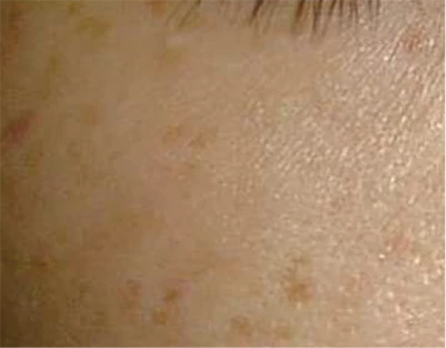 なのはな耳鼻咽喉科　施術7日後 