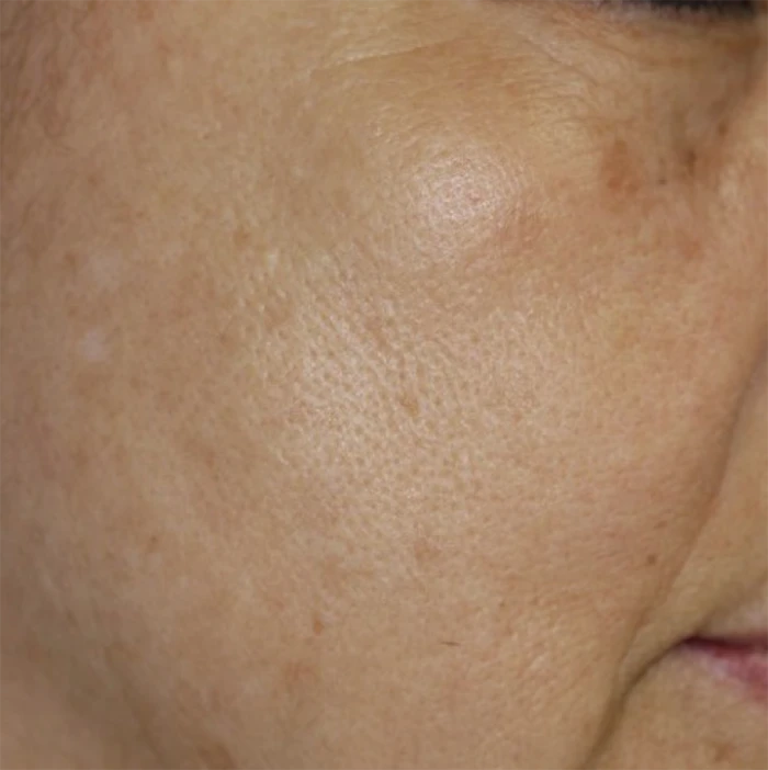 なのはな耳鼻咽喉科　After 5 treatments