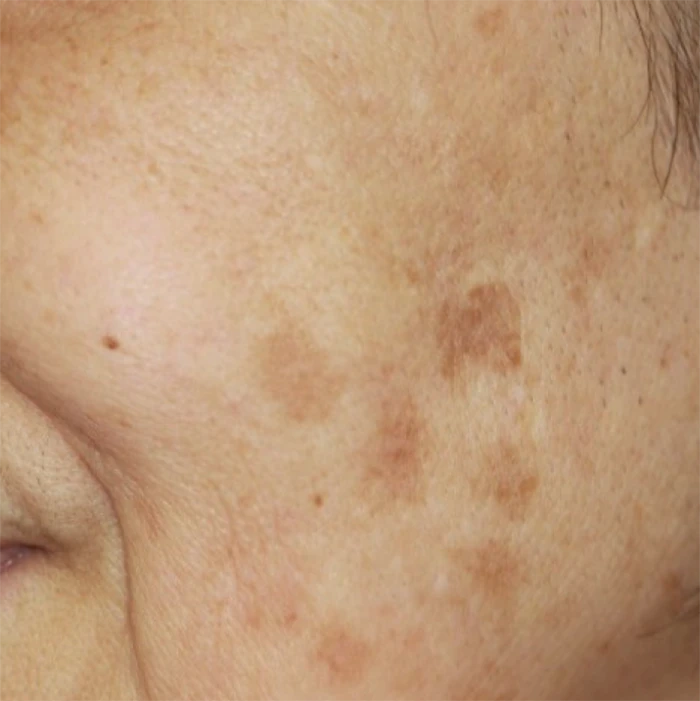 なのはな耳鼻咽喉科　After 3 treatments