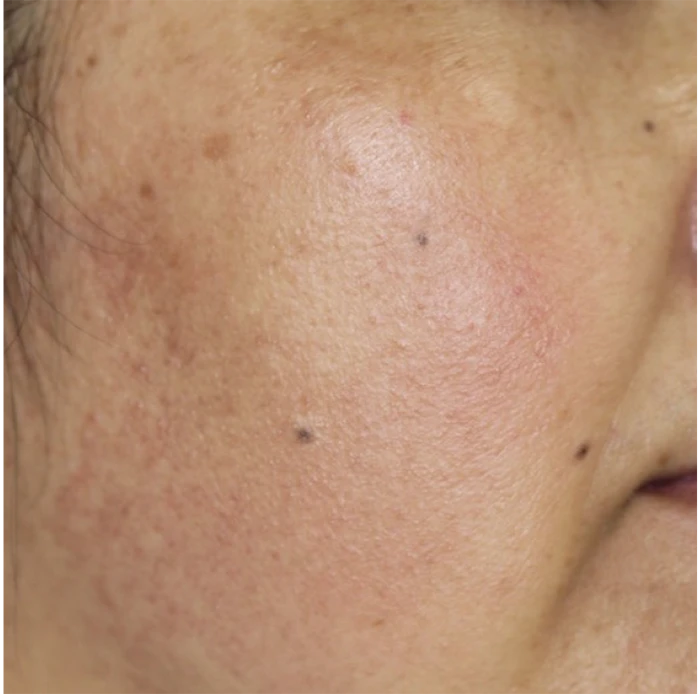 なのはな耳鼻咽喉科　After 3 treatments