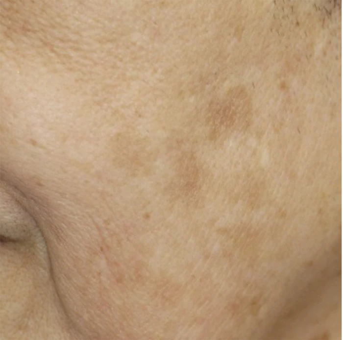 なのはな耳鼻咽喉科　After 5 treatments