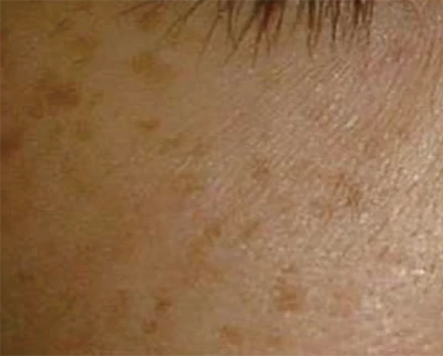 なのはな耳鼻咽喉科　施術前