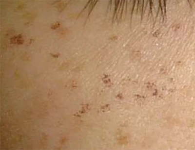 なのはな耳鼻咽喉科　施術2日後