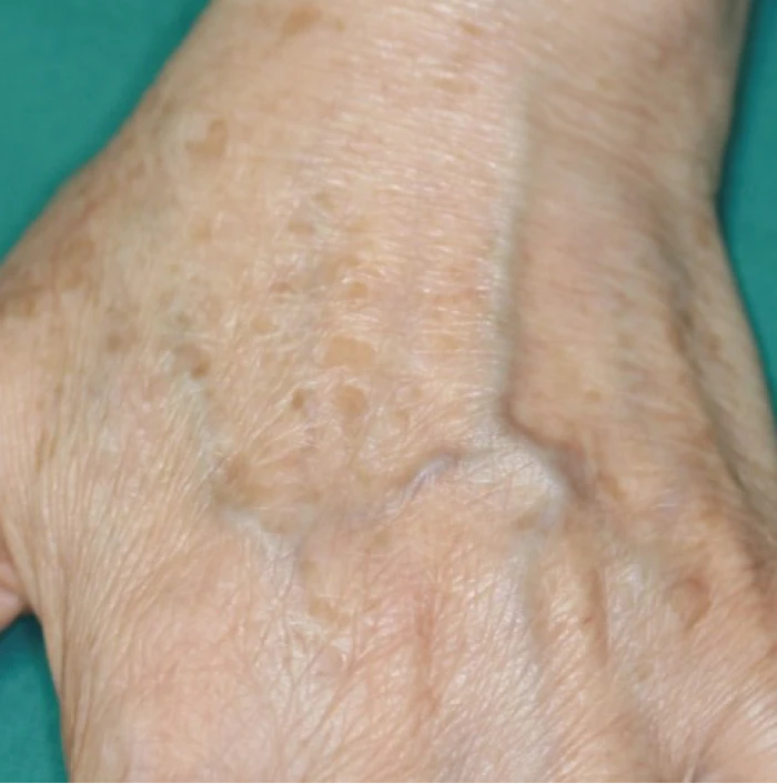 なのはな耳鼻咽喉科　After 4 treatments