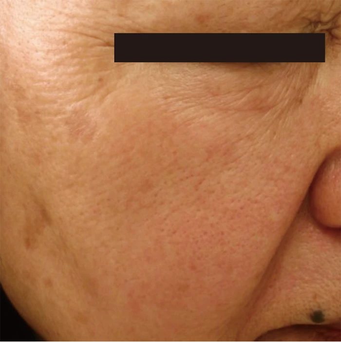 なのはな耳鼻咽喉科　After 3 treatments